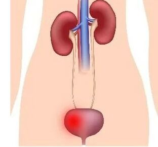 Le ragioni dello sviluppo della cistite nelle donne