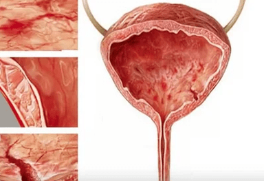Le ragioni dello sviluppo della cistite nelle donne