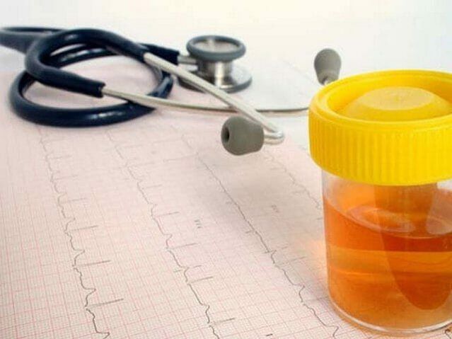 analisi delle urine per diagnosticare la cistite